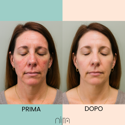 Trattamento Mirato per Acne e Segni post Acne