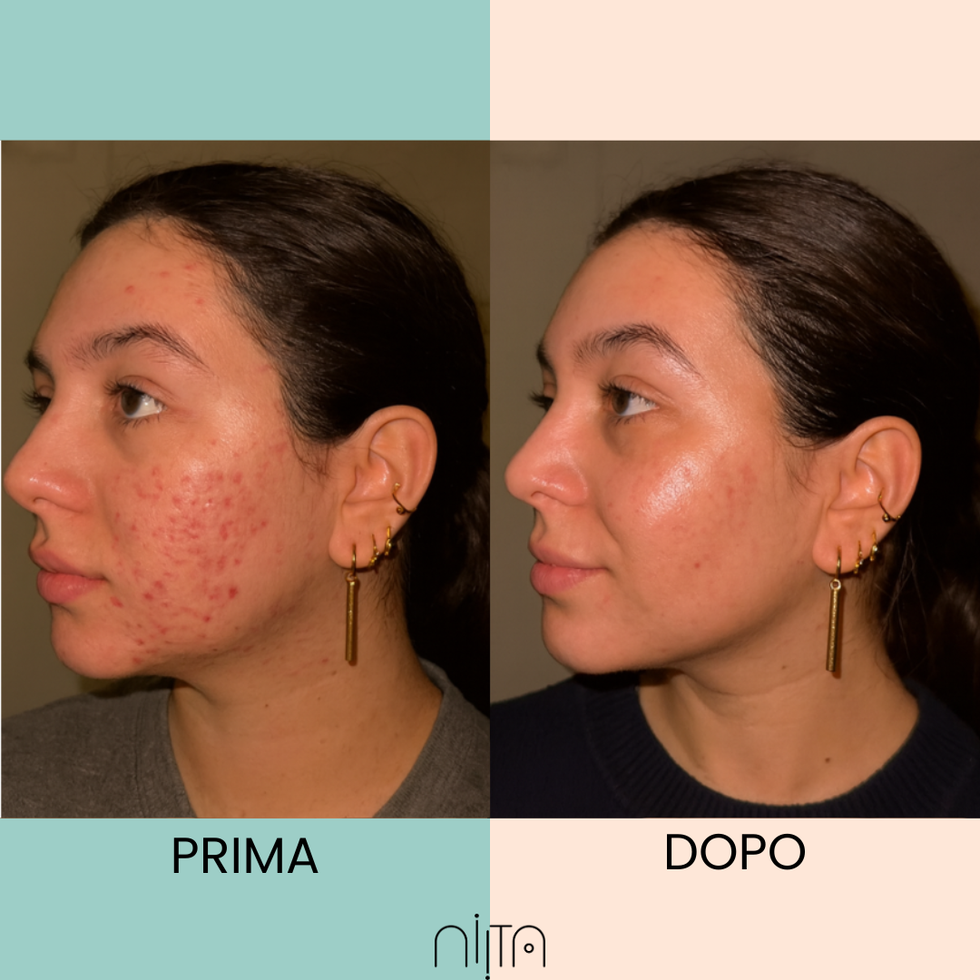 Trattamento Mirato per Acne e Segni post Acne