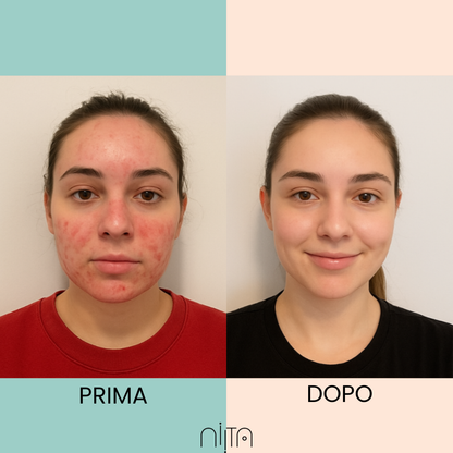 Trattamento Mirato per Acne e Segni post Acne