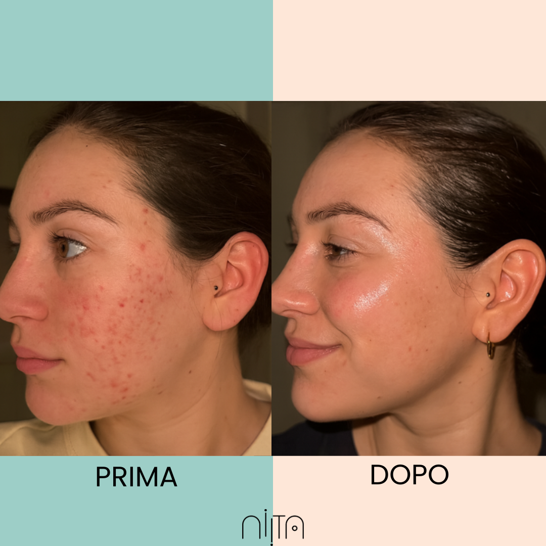 Trattamento Mirato per Acne e Segni post Acne